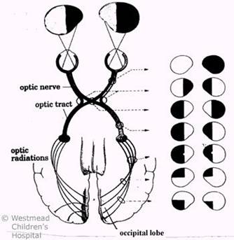 lesion of optic chiasm upper quadrant defect > lower quadrant defect ...